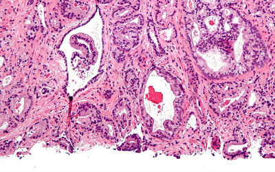 La prostate